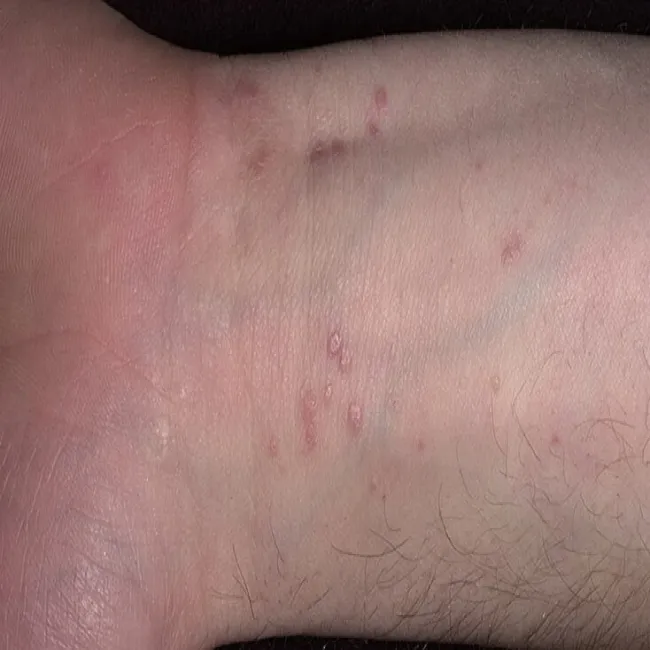 Liszaj płaski na nadgarstku