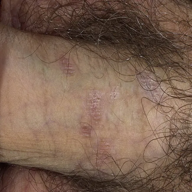 Liszaj płaski na narządach płciowych