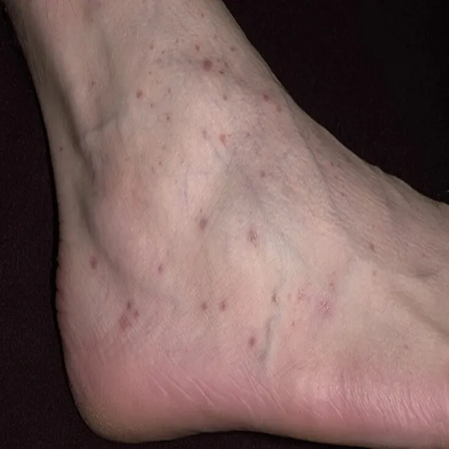 Liszaj płaski na stopie