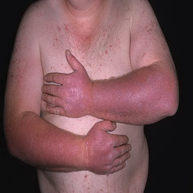 Liszaj płaski u mężczyzny