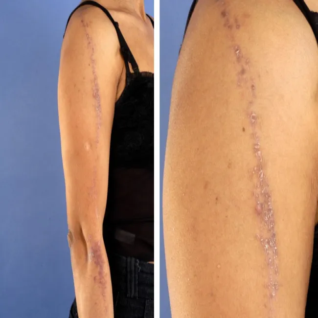 Liszaj płaski zdjęcie