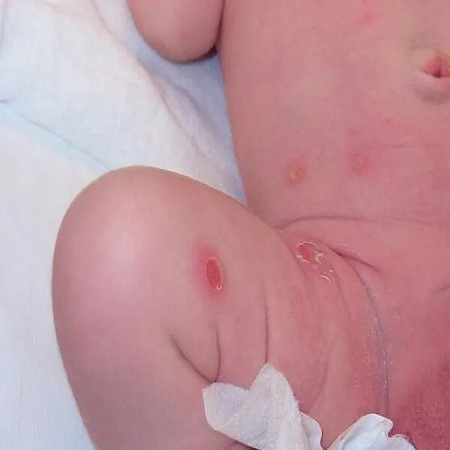 Liszajec noworodkowy