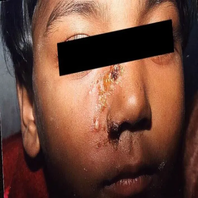 Liszajec na nosie u dziecka