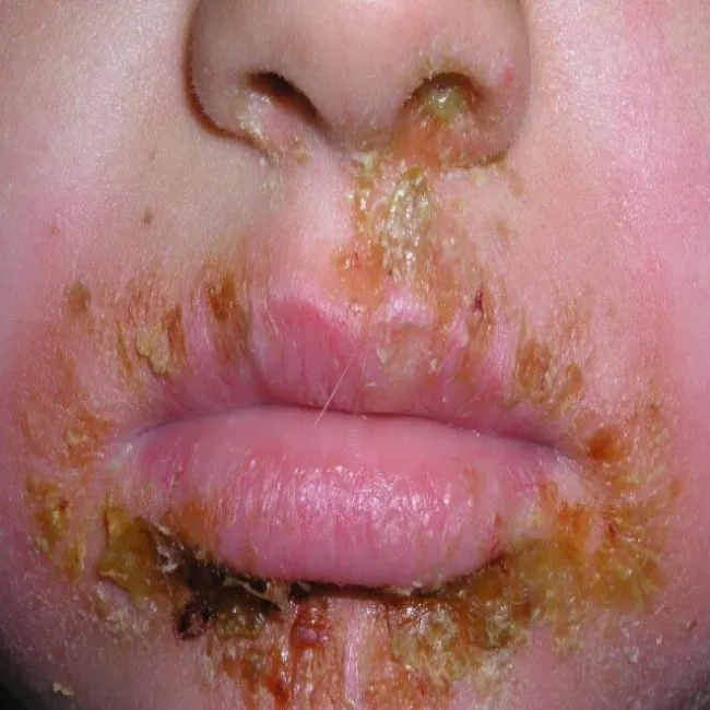 Liszajec wysypka koło ust