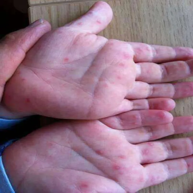 Małe czerwone plamki na dłoniach u dziecka