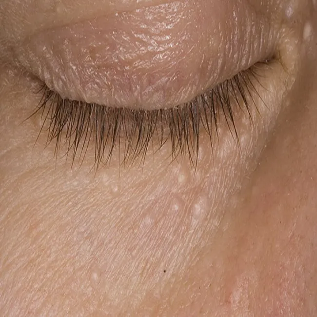 Małe, białe grudki syringoma