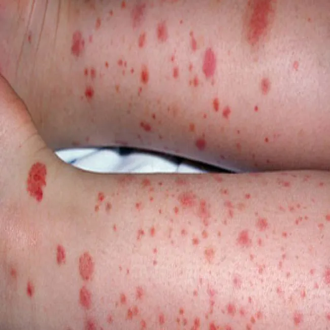 Małopłytkowość immunologiczna