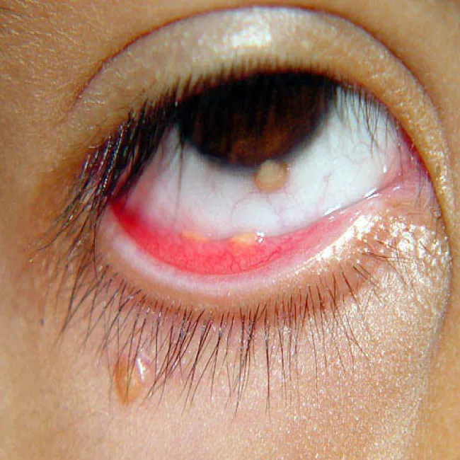 Mały guzek pod okiem żółtakoziarniniakowatość młodzieńcza 