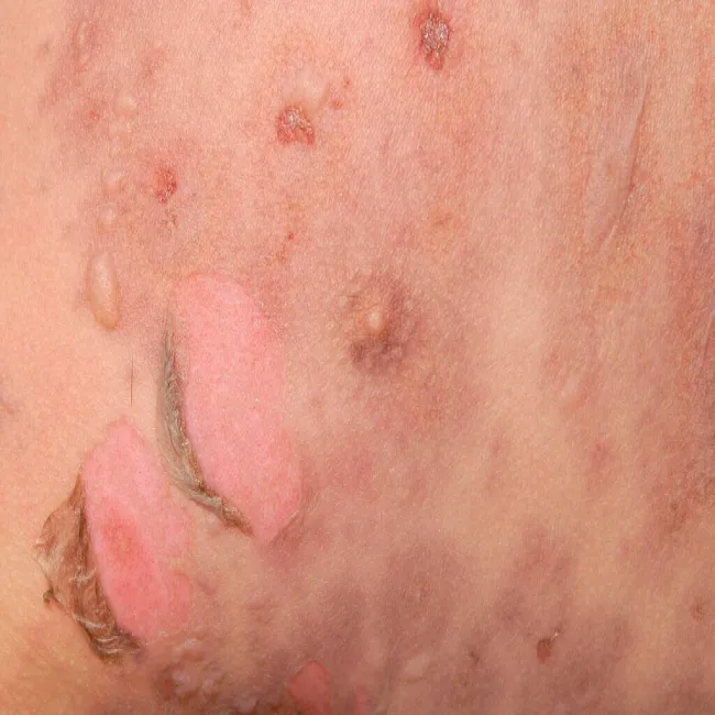 Martwica skóry po zażyciu leków