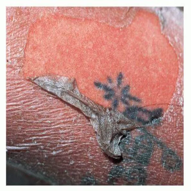 Martwica toksyczna rozpływna naskórka choroba