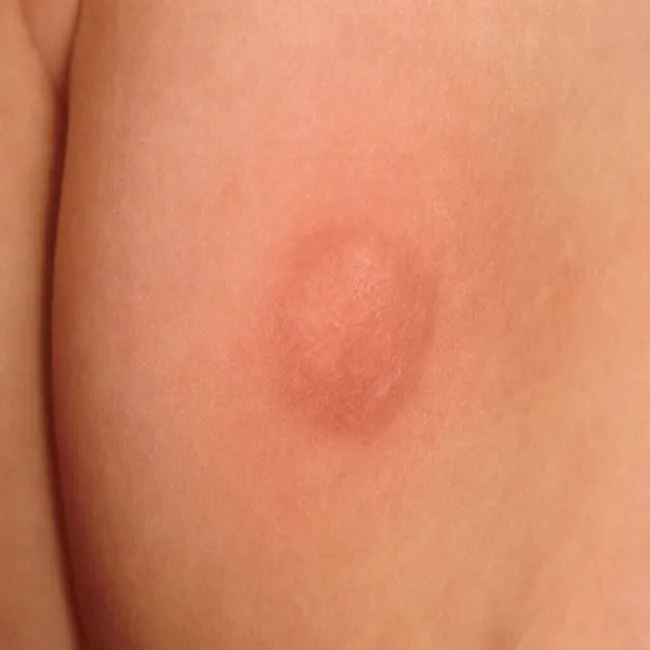 Mastocytoza skórna jak wygląda u dziecka