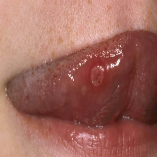 Mastocytozy na języku