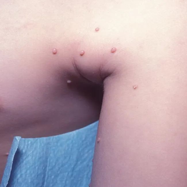 Mięczak zakaźny koło pachy