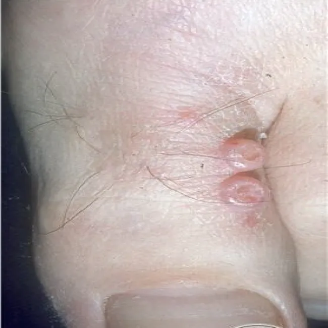 Mięczak zakaźny na palcu