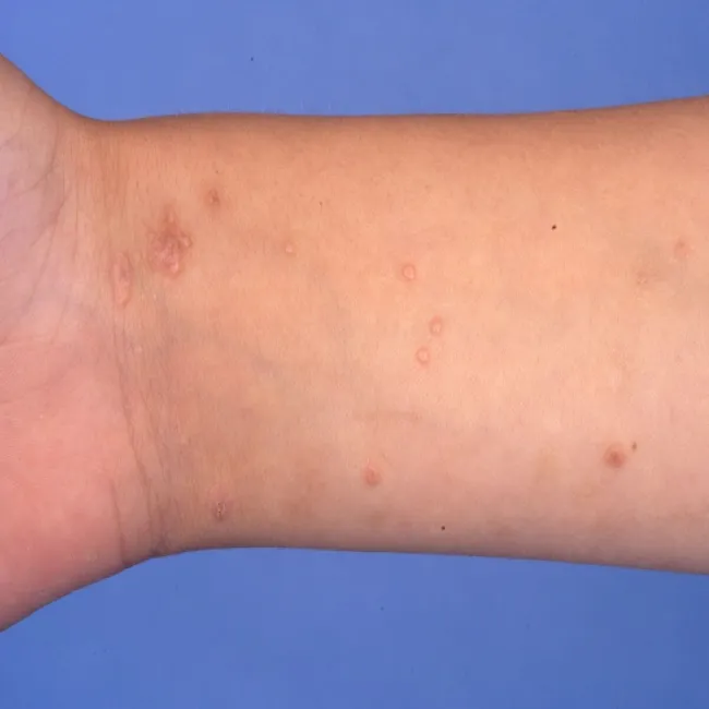 Mięczak zakaźny na ręce u dziecka