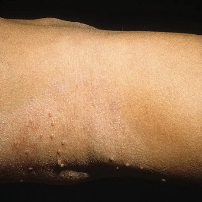 Mięczak zakaźny na ręce