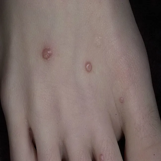 Mięczak zakaźny na stopie