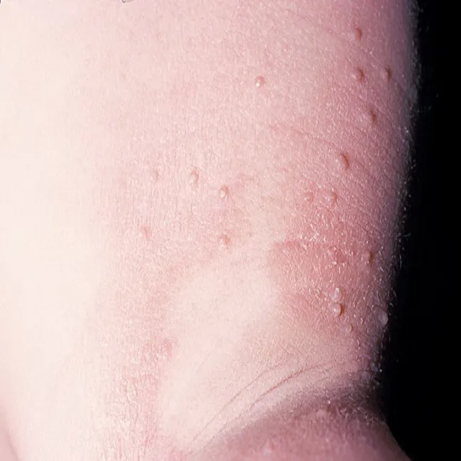 Mięczak zakaźny objawy