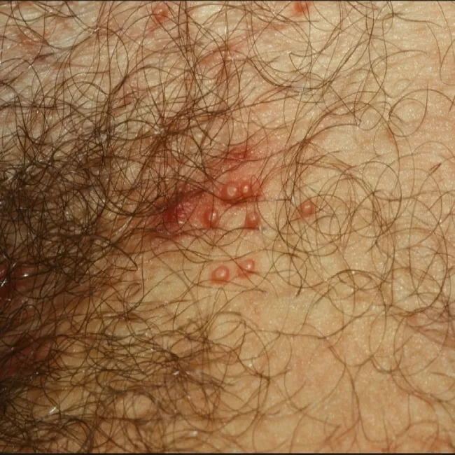 Mięczak zakaźny okolic intymnych