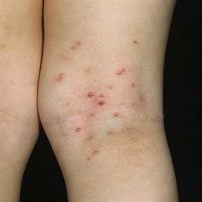 Mięczak zakaźny wysypka na nogach 