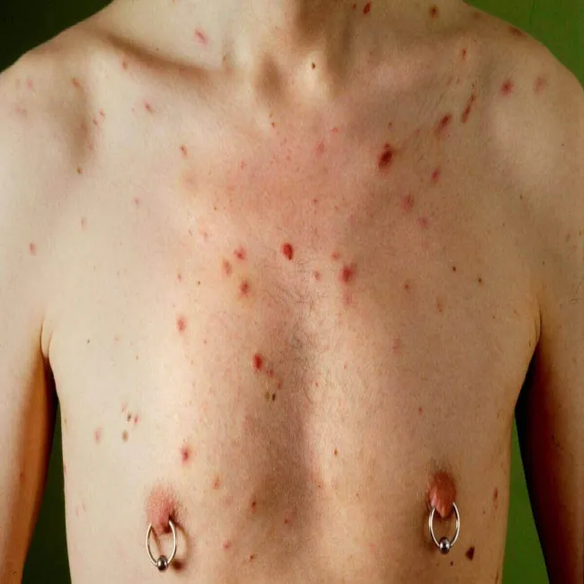 Mięsak Kaposiego u chorego na HIV