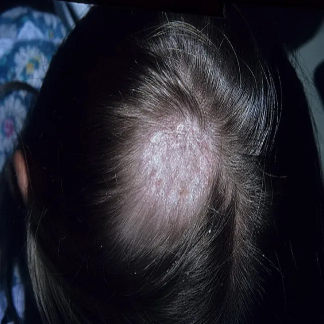 Microsporum canis grzybica skóry głowy