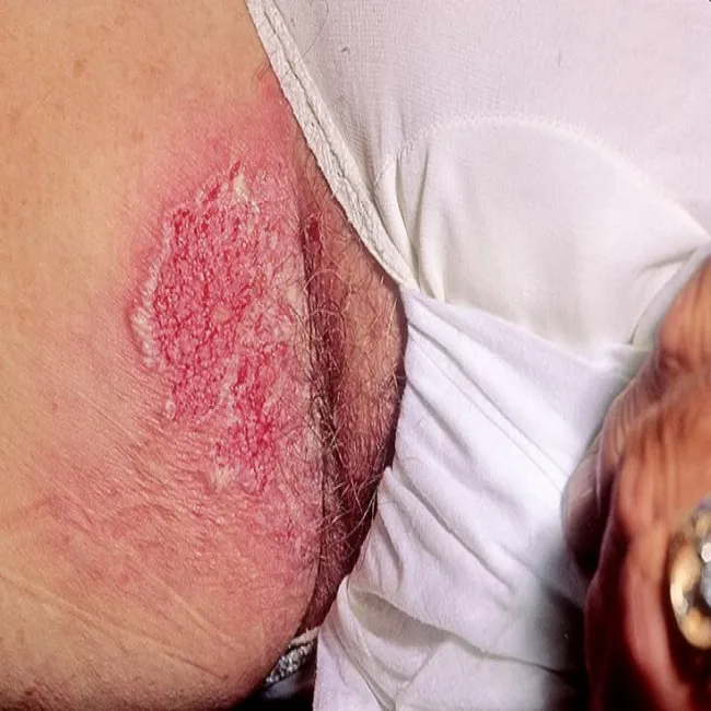 Miejsca intymne zaczerwienienie choroba Haileya-Haileya