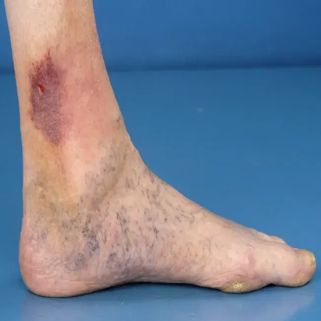 Miejscowe zaczerwienienie skóry nogi wyprysk podudzi