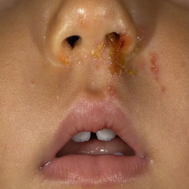 Miodowo-żółte strupy liszajec zakaźny