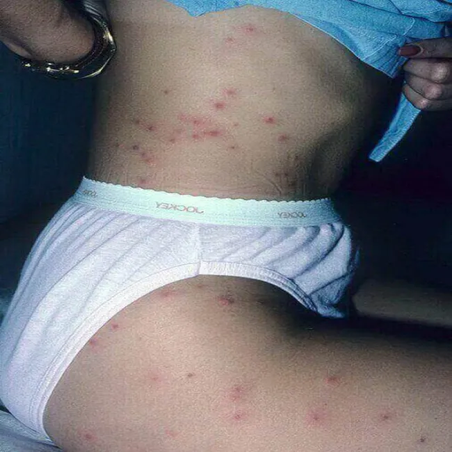 Na ciele czerwone kropki zapalenie mieszków włosowych