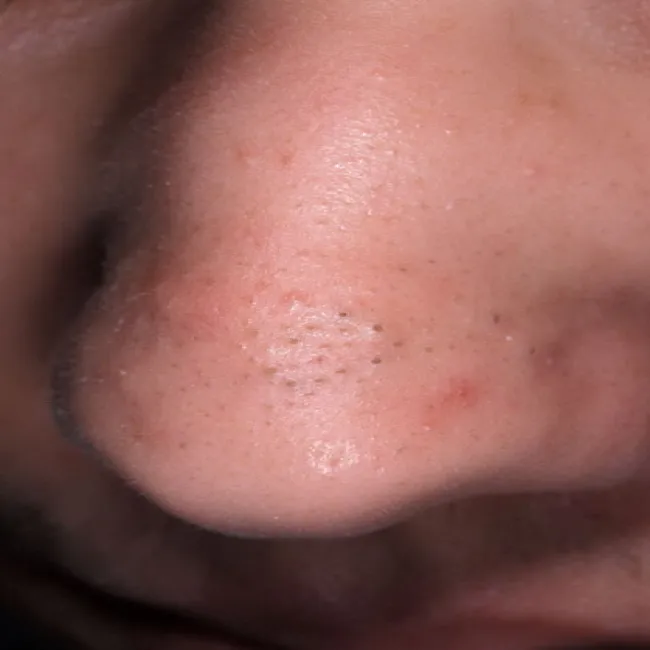 Na nosie czarne kropki zaskórniki otwarte 