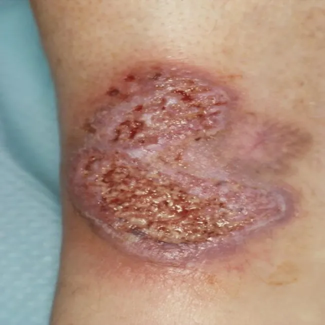 Naciek z lekko czerwonawą obwódką na skórze piodermia zgorzelinowa