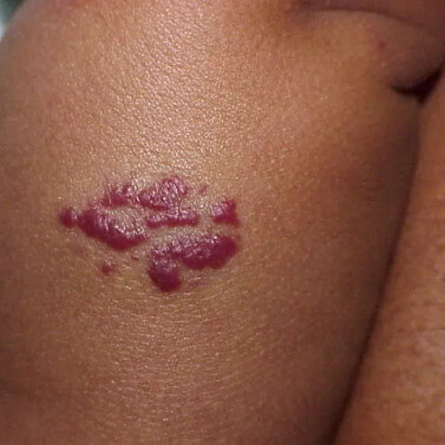 Naczyniak prosty zdjęcie