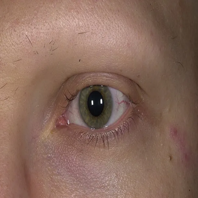 Nadmierna utrata włosów brwi i rzęs łysienie plackowate