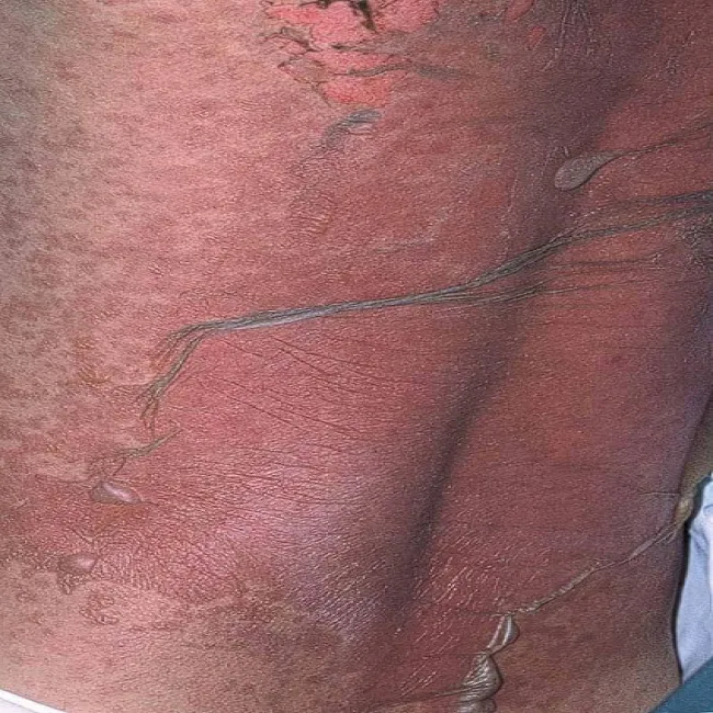 Nadwrażliwość na leki 