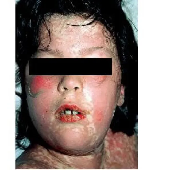 Nadwrażliwość na leki u dzieci 