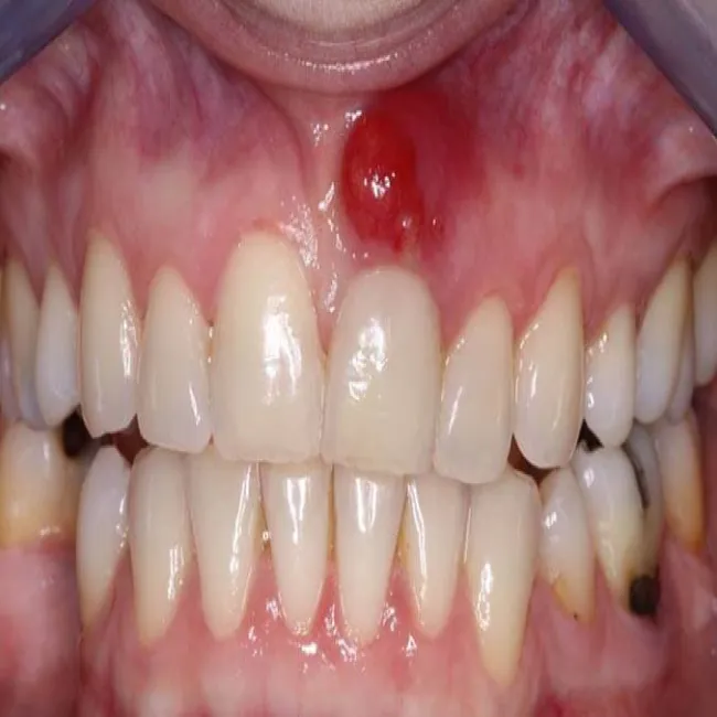 Nadziąślak zdjęcie