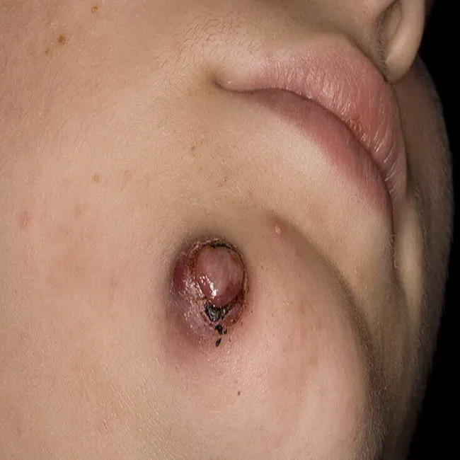 Narośl guzek pod brodą ziarniniak