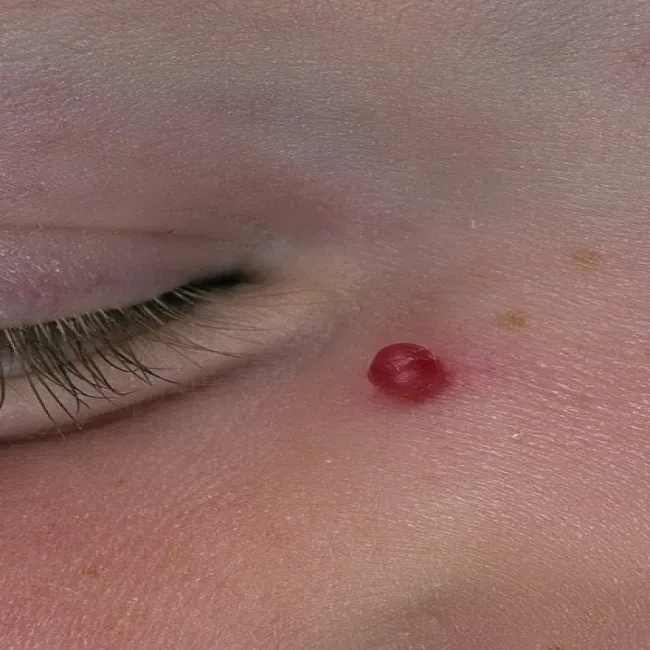 Narośl koło oka ziarniniak
