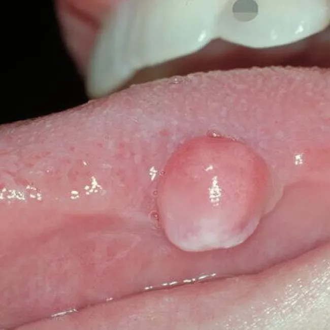 Narośl na języku ziarniniak naczyniowy