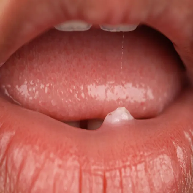 Narośl na ustach włókniak