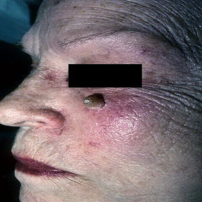 Narośl pod okiem róg skórny