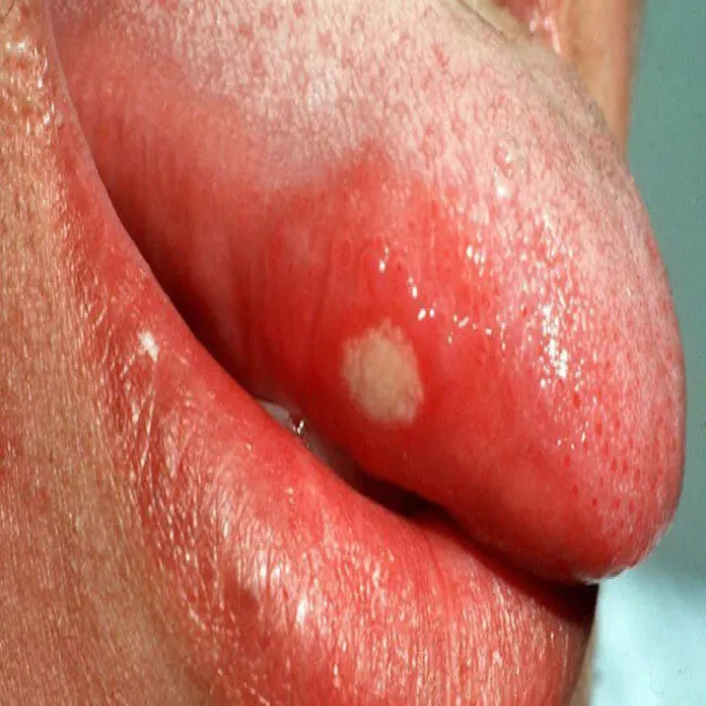 Narośl z boku języka ropień na języku