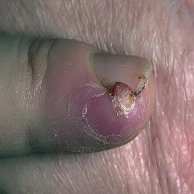 Narośl z boku paznokcia