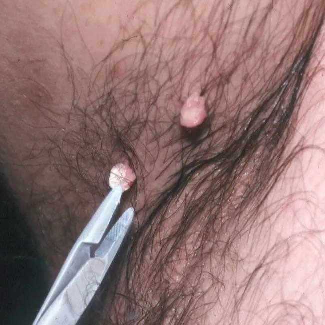 Narośla na skórze pod pachą włókniaki