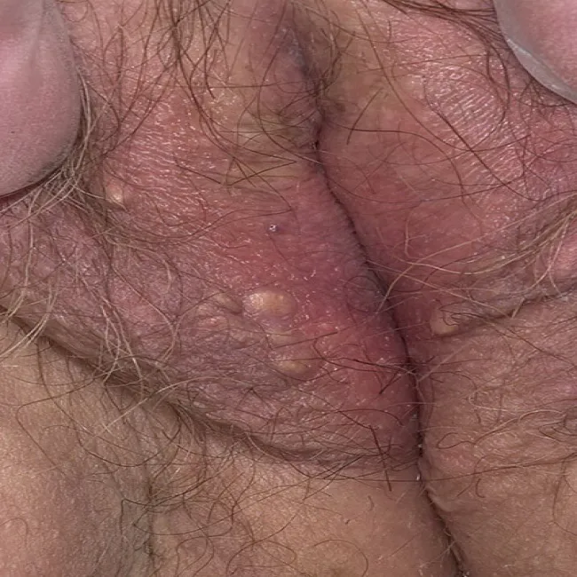 Niebolący guzek na wargach sromowych