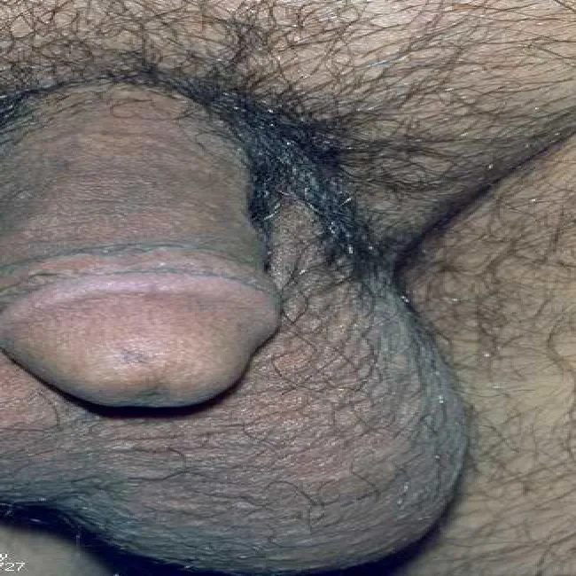 Niebolesne powiększenie jądra wodniak 