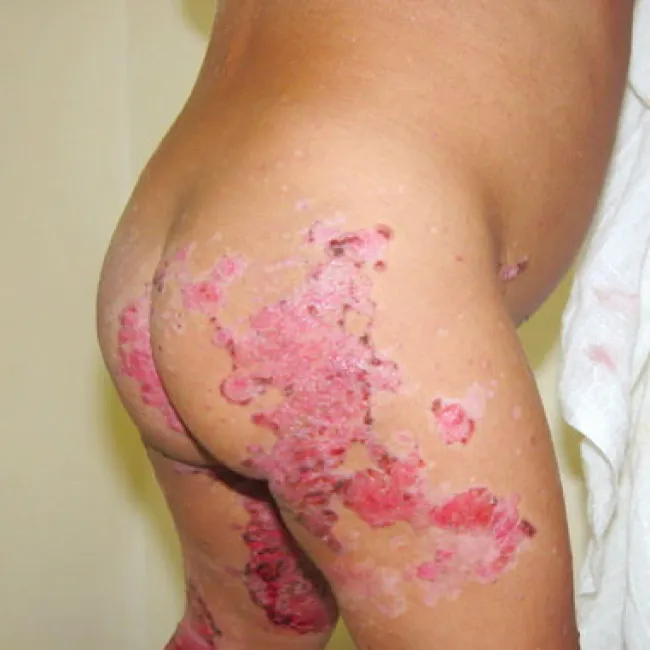 Niedobór cynku objawy skórne u dziecka zespół Brandta