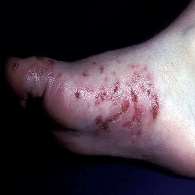 Niedobór cynku objawy zespół Brandta