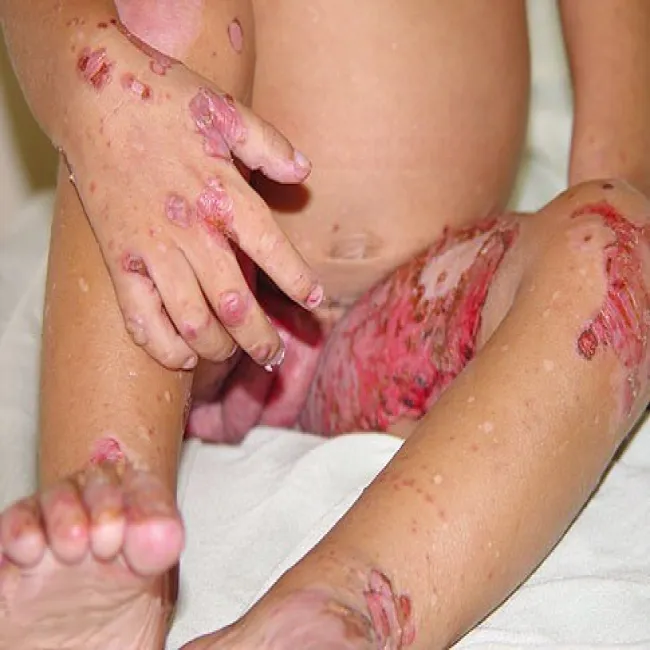 Niedobór cynku u dzieci zespół Brandta